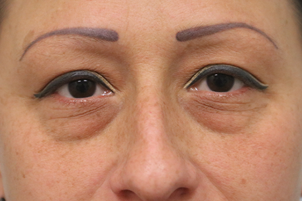 before blepharoplasty in the woodlands texas