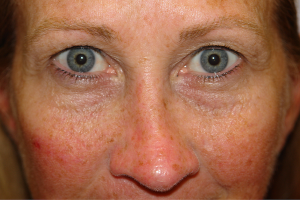 before eyelid surgery in the woodlands texas