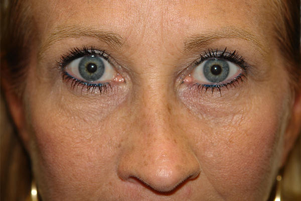 after eyelid surgery in the woodlands texas