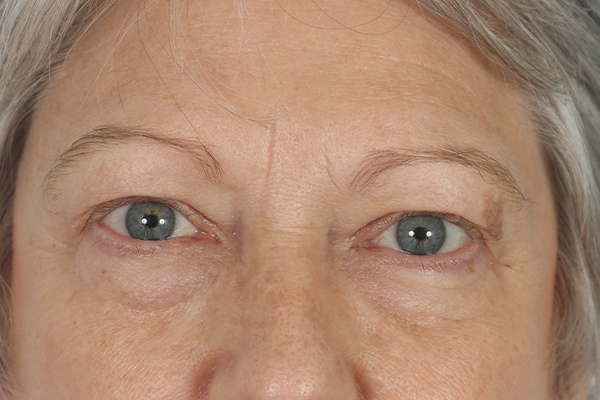 before female blepharoplasty in shenandoah texas