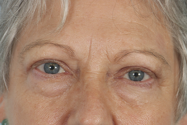 after blepharoplasty in shenandoah texas